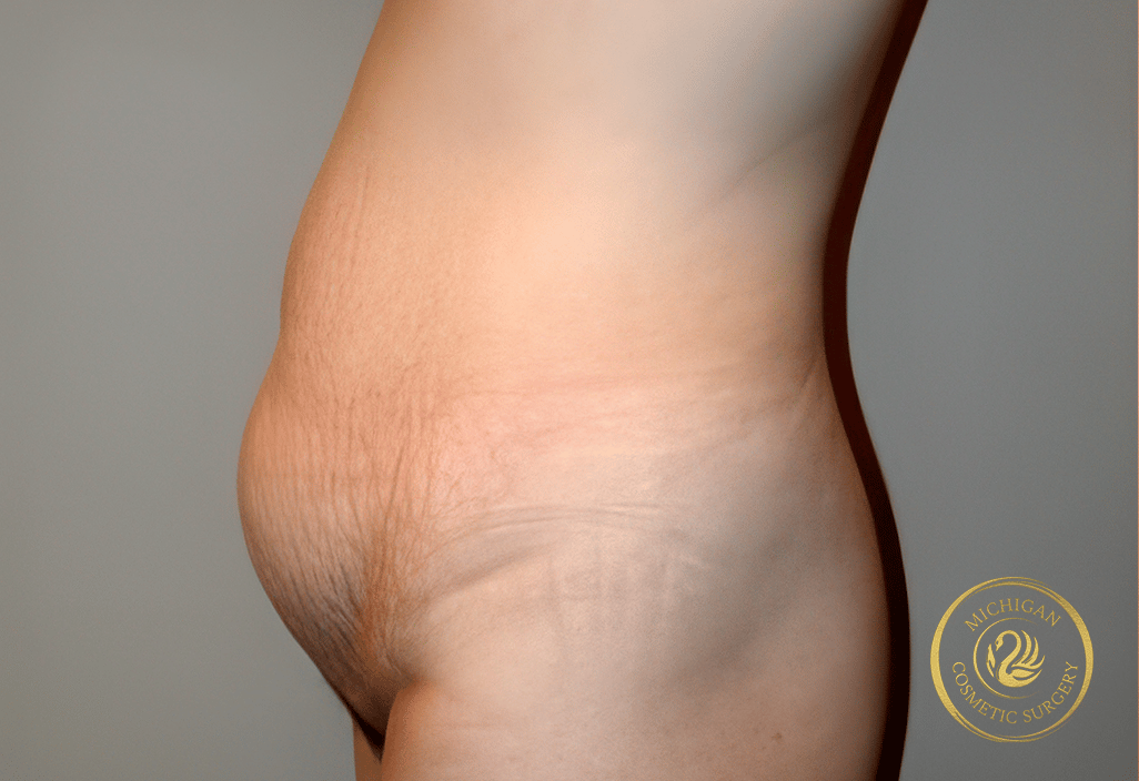 tummy tuck after photo by michigan cosmetic surgery in southfield mi tummy tuck before photo by michigan cosmetic surgery in southfield mi