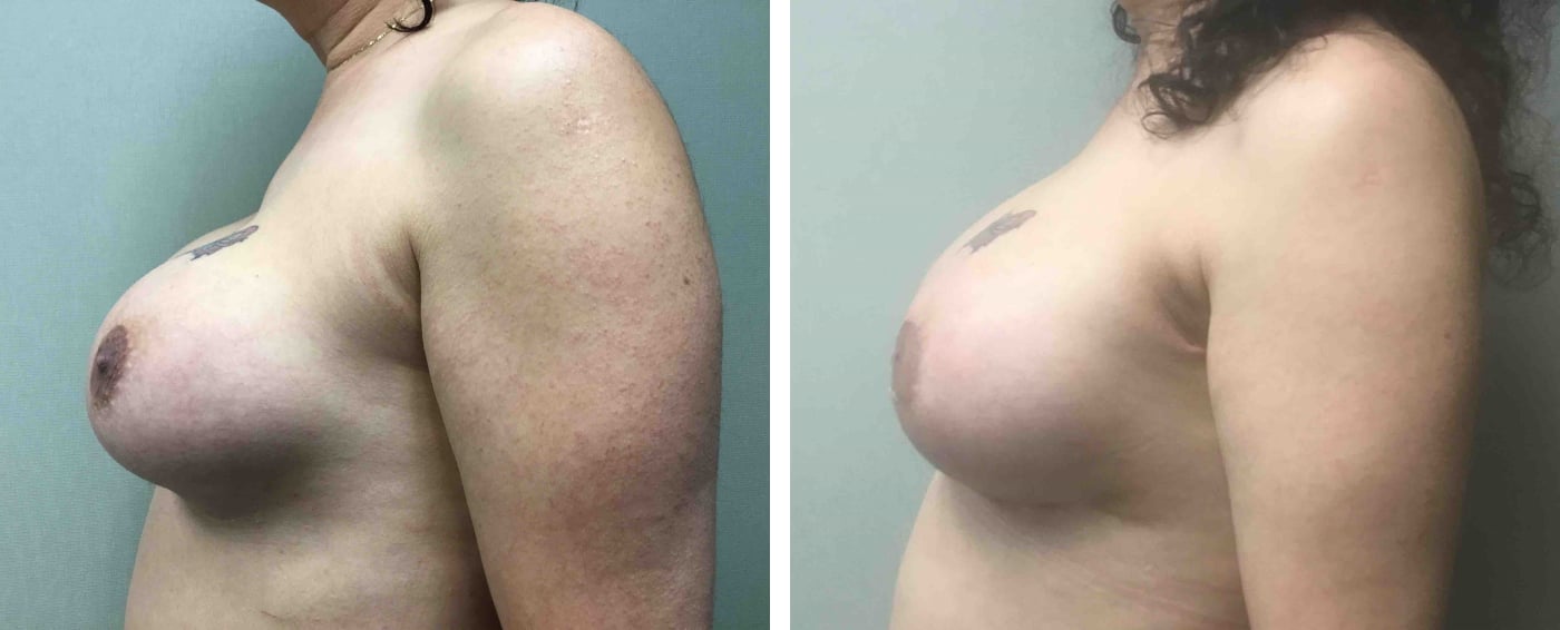 Breast Implant Removal and Replacement in Michigan c