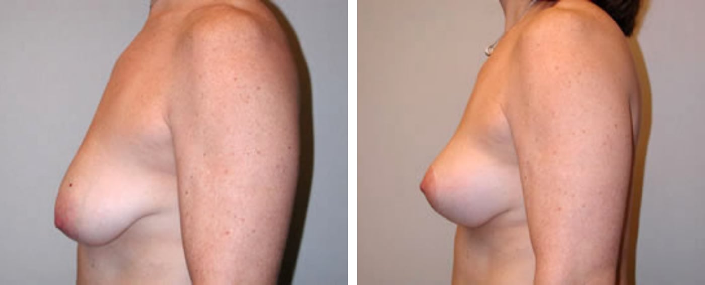 Breast lift c