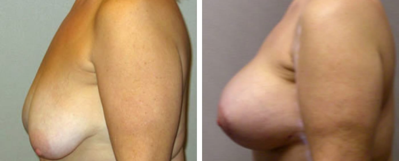 Breast Augmentation with Lollipop Lift b