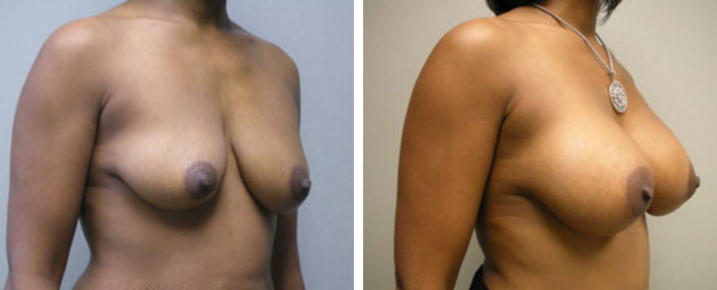 Breast Aug Periareolar lift b