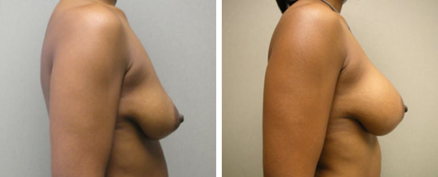 Breast Aug Periareolar lift c
