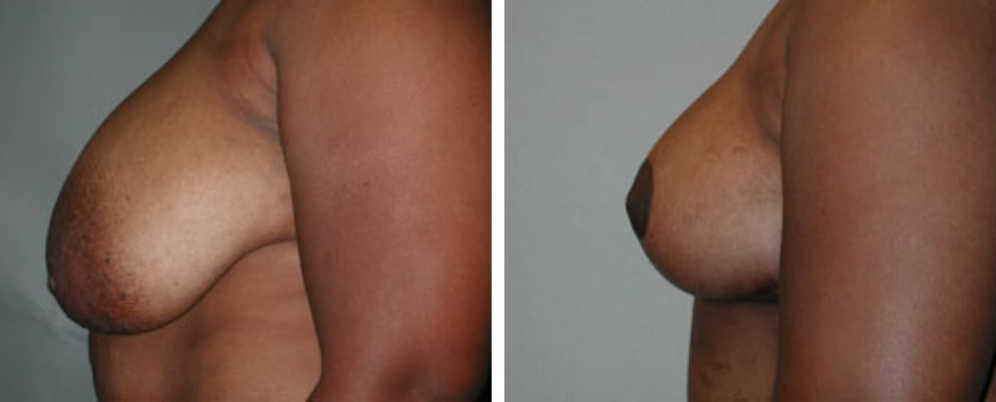 Breast lift c