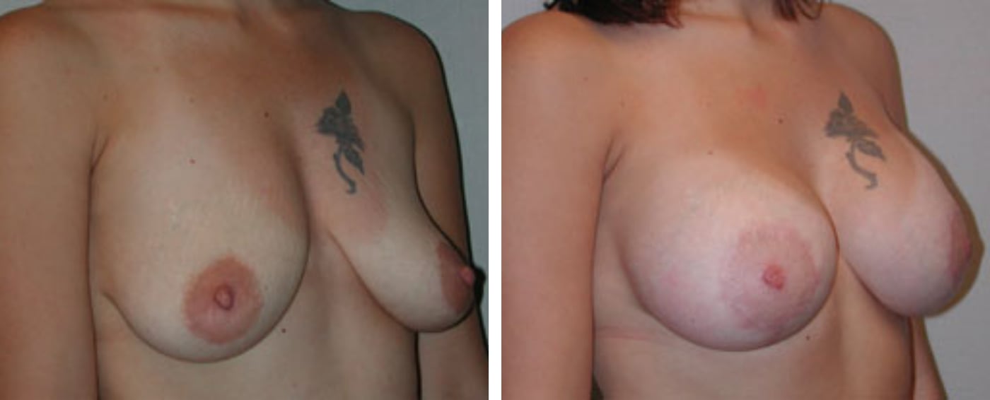 Breast Aug Periareolar lift b