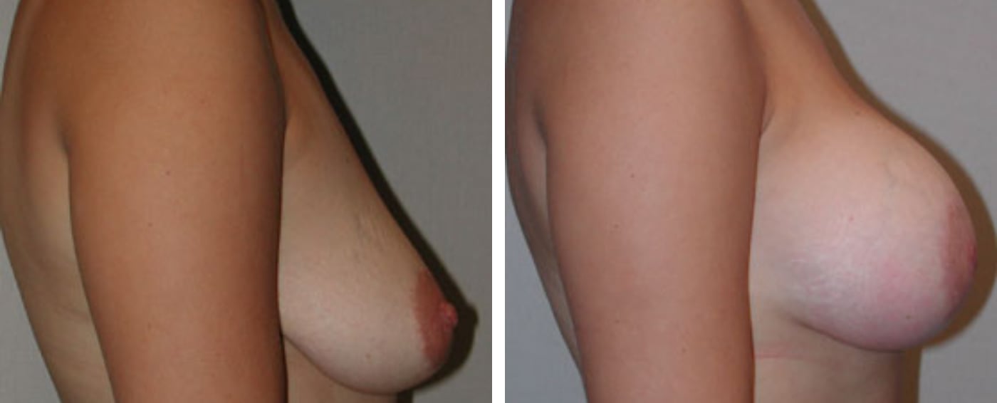 Breast Aug Periareolar lift c