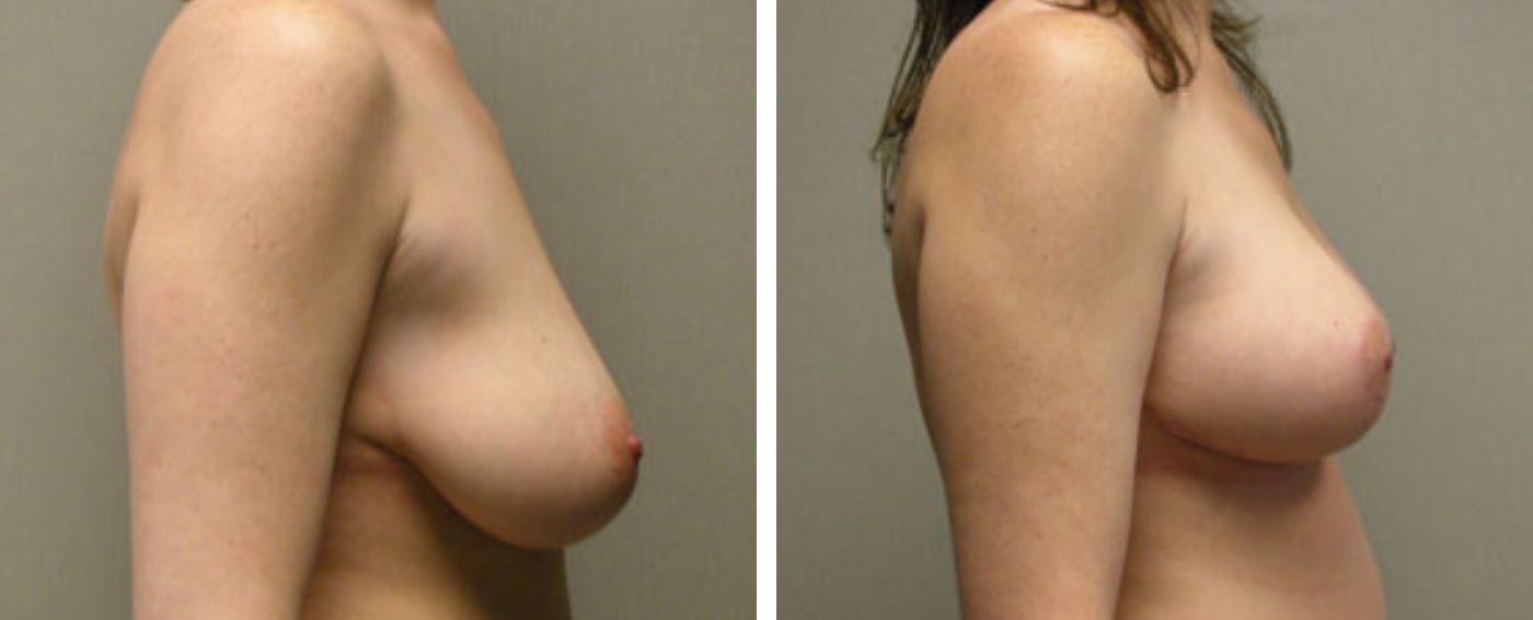 Breast lift c