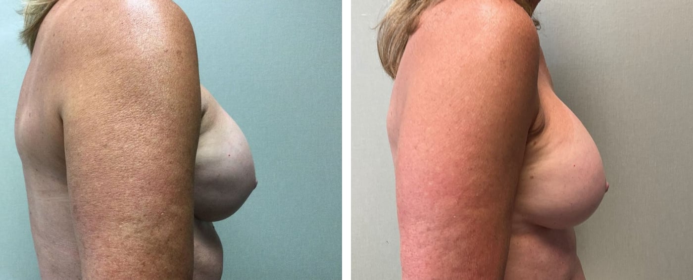 Breast Implant Removal and Replacement in Michigan c