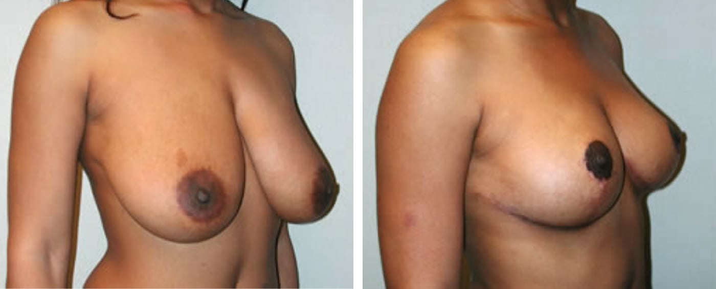 Breast lift b