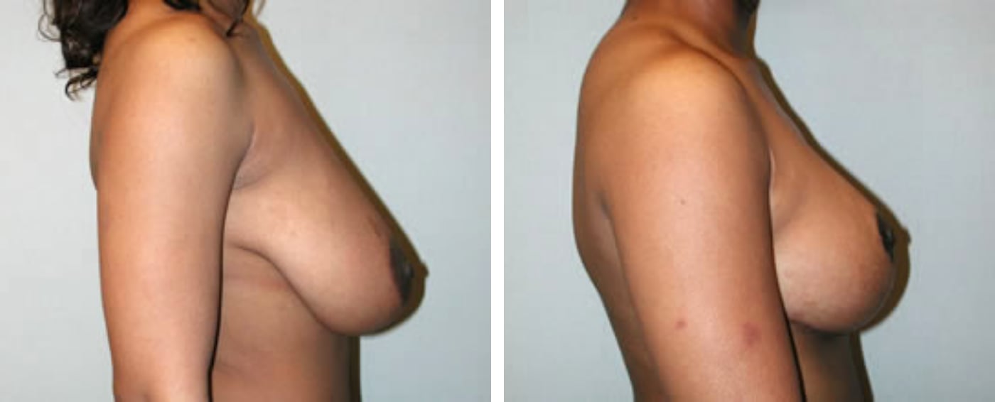 Breast lift c