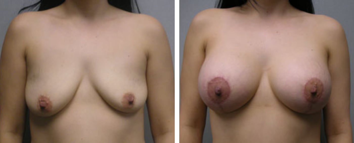 Breast Aug Periareolar lift a