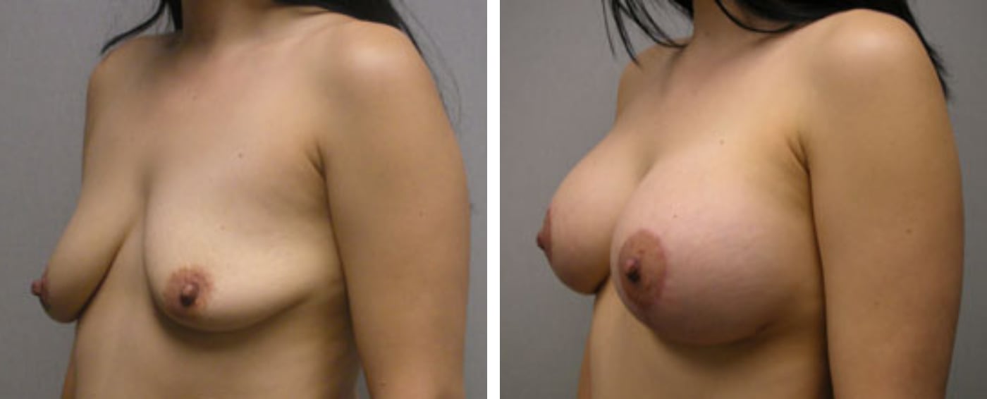 Breast Aug Periareolar lift b