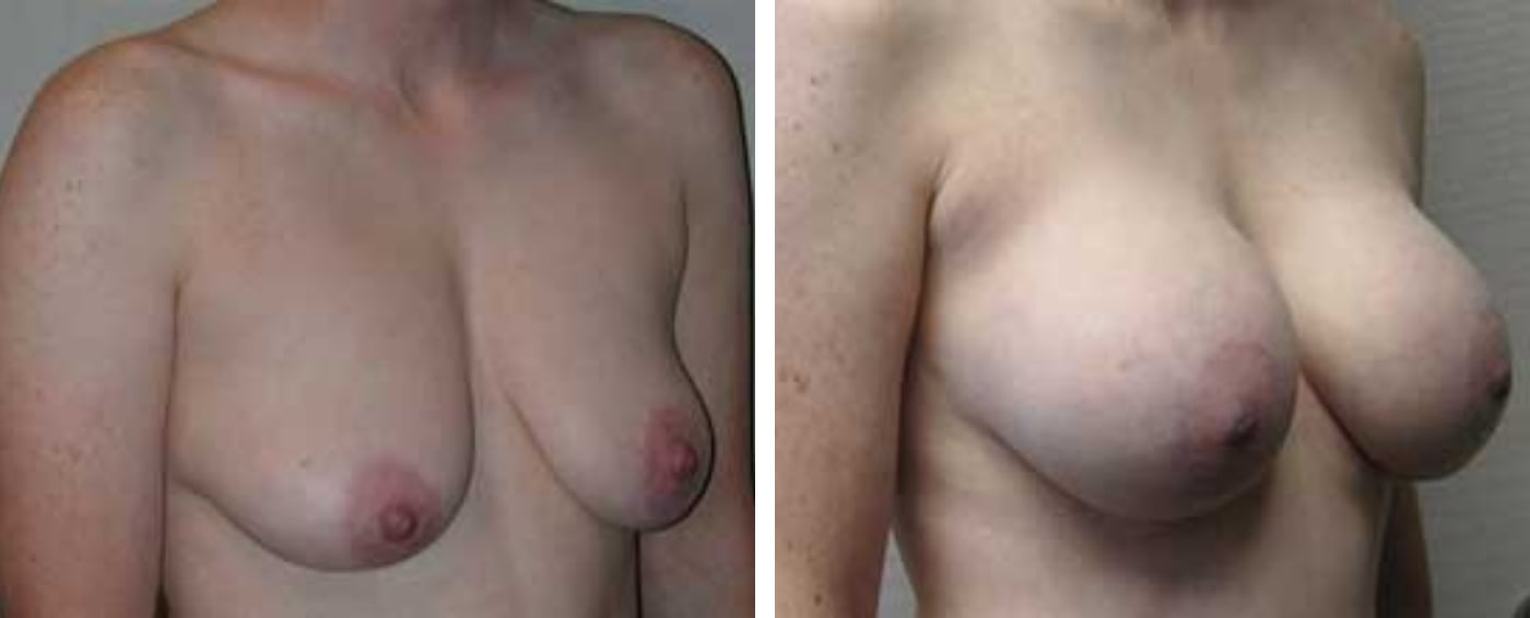 Breast Augmentation with Lollipop Lift b