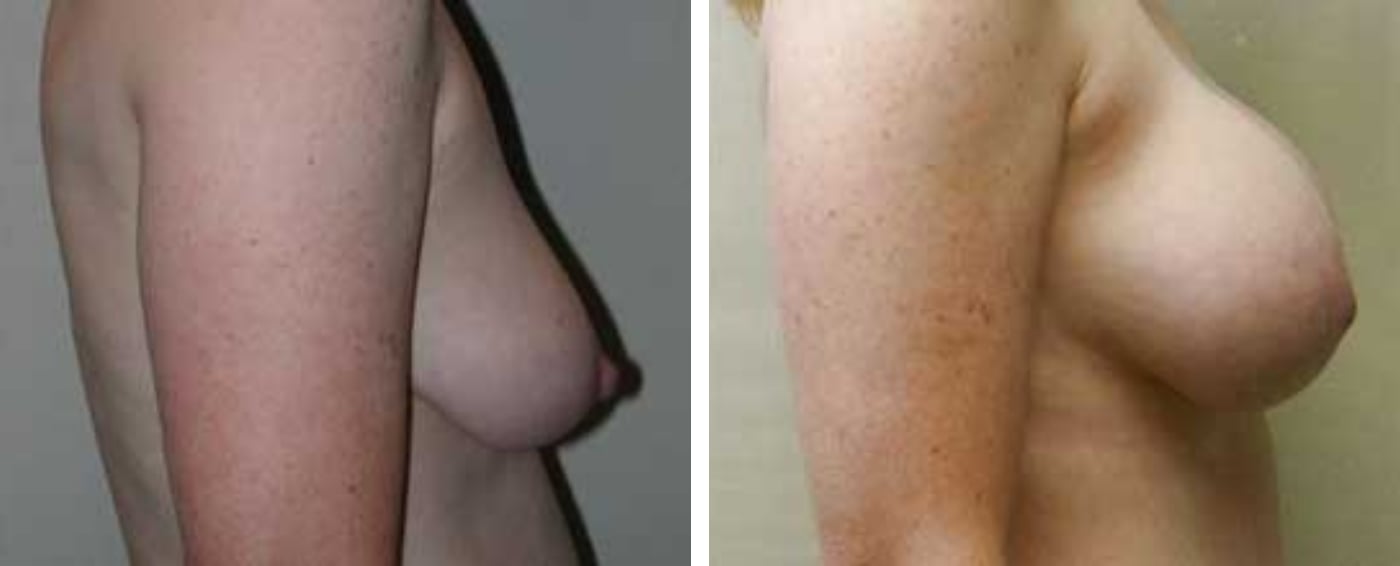 Breast Augmentation with Lollipop Lift c