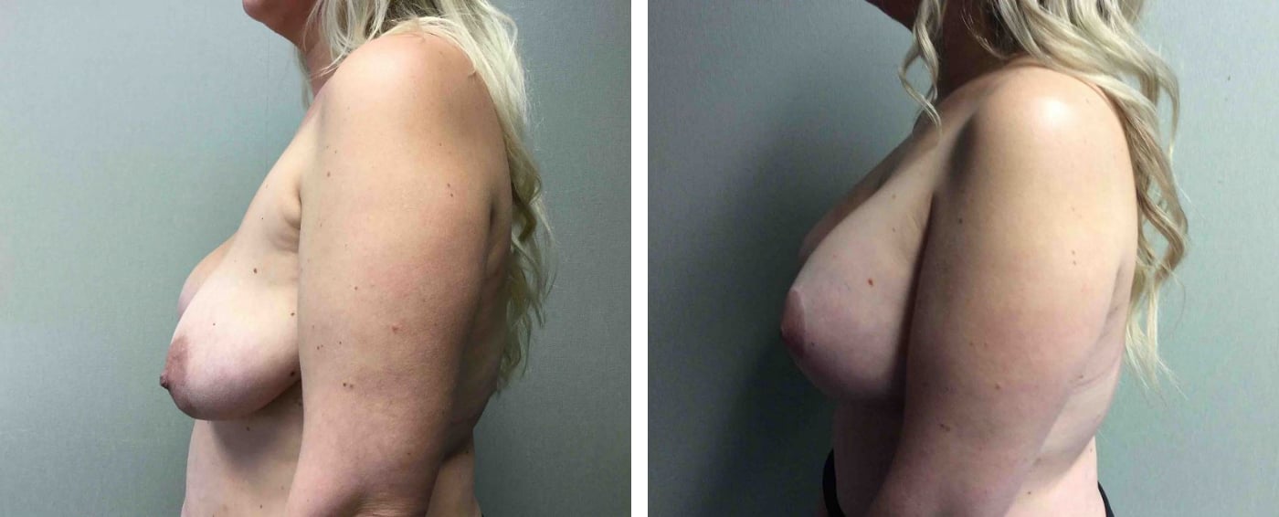 Breast Implant Removal and Replacement in Michigan b