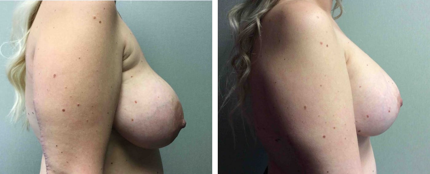 Breast Implant Removal and Replacement in Michigan c