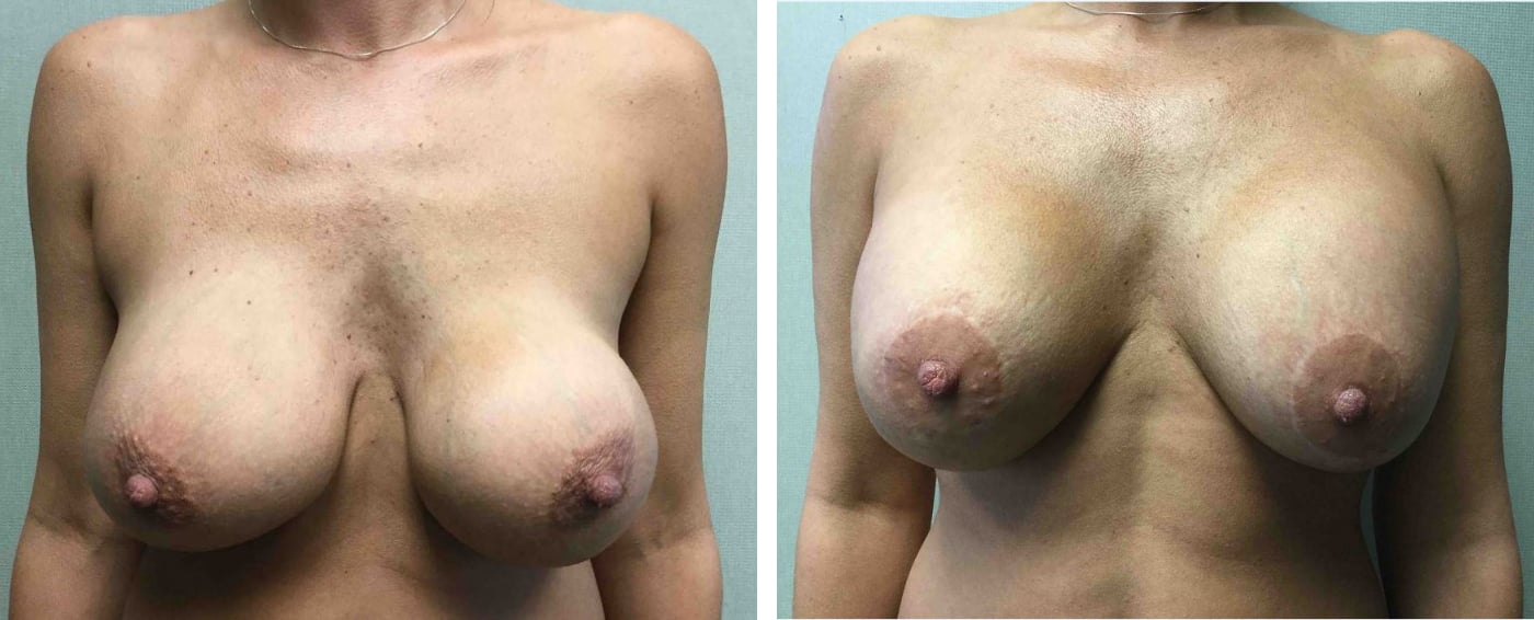 Breast Implant Removal and Replacement in Michigan a