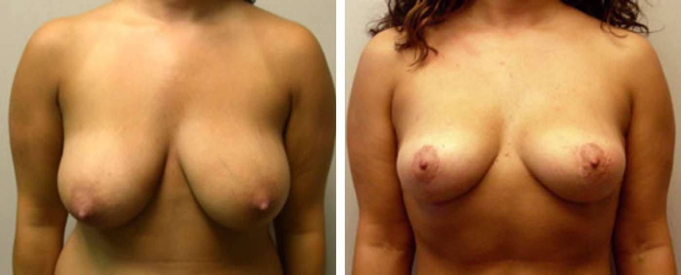 Breast lift a