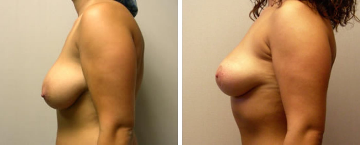 Breast lift c