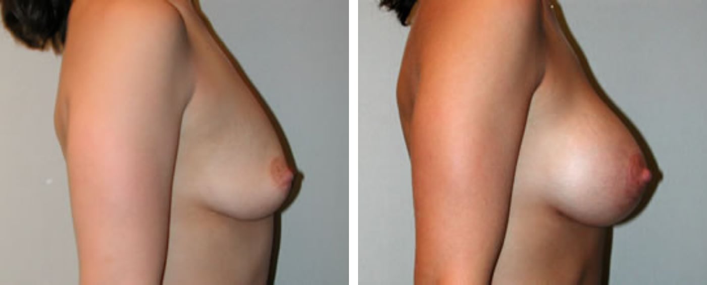 Breast Aug Periareolar lift c
