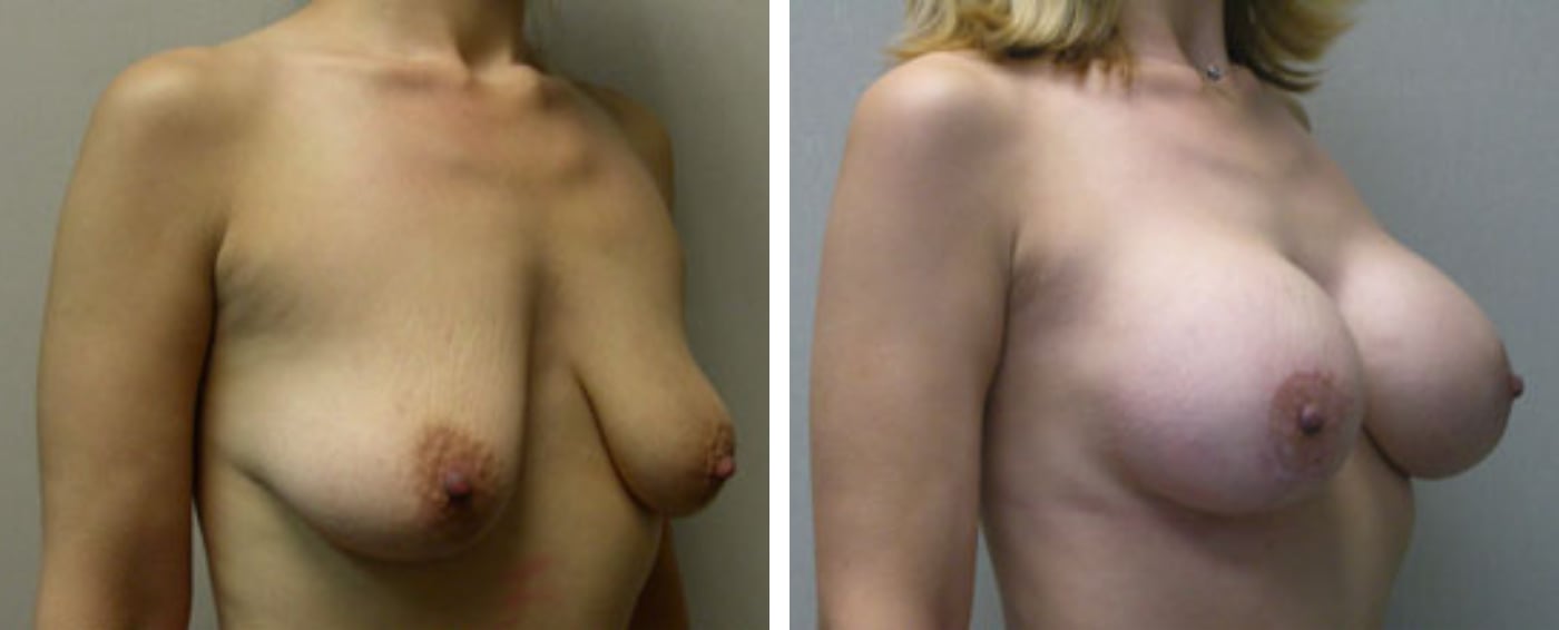 Breast Augmentation with Lollipop Lift b