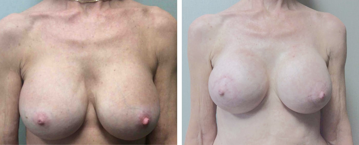 Breast Implant Removal and Replacement in Michigan a