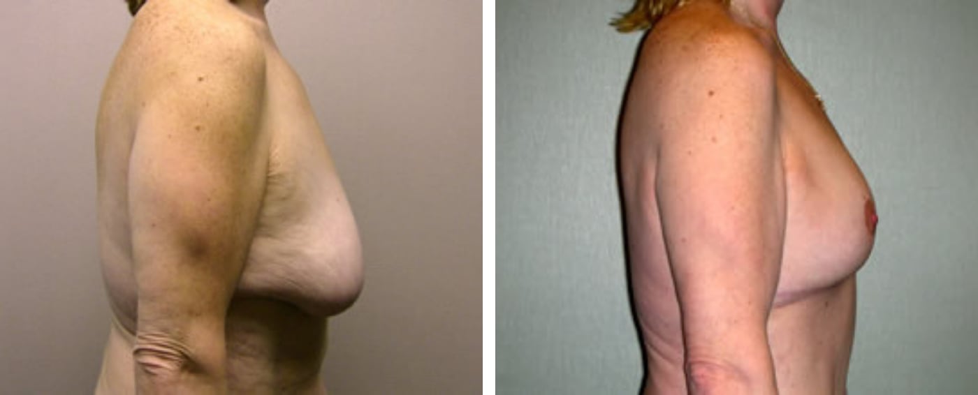 Breast lift c