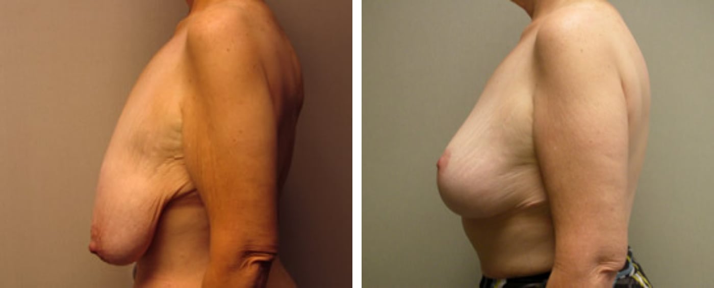 Breast lift c