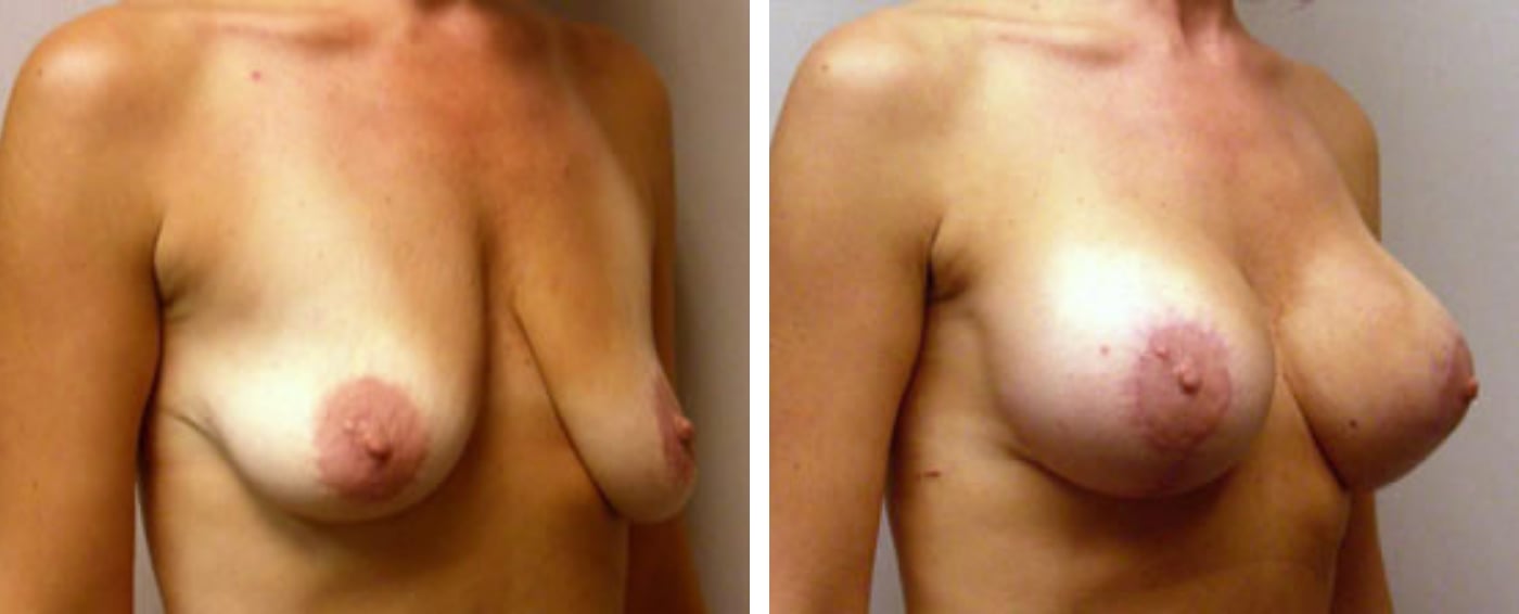 Breast Augmentation with Lollipop Lift b