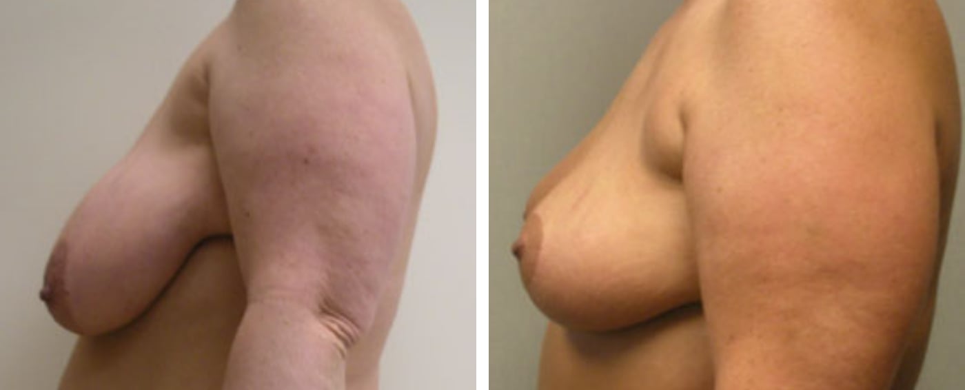 Breast lift C