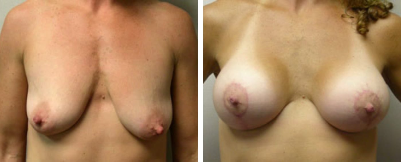 Breast Augmentation with Lollipop Lift a