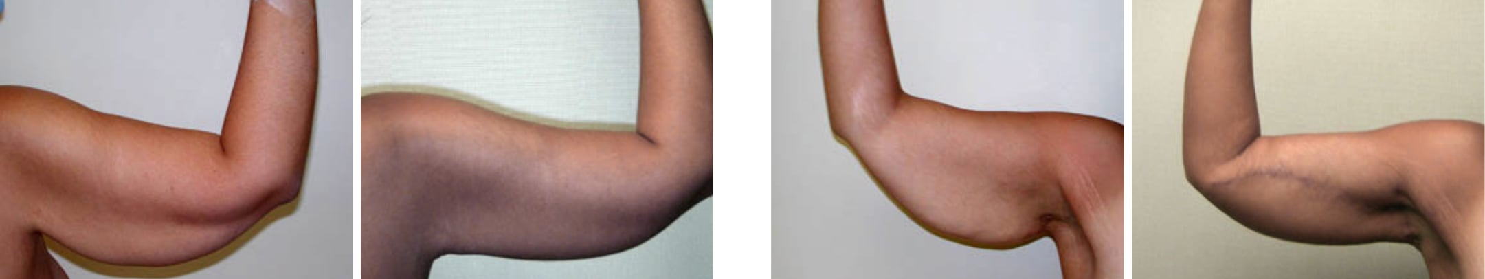 Best Arm Lift In Michgian ()
