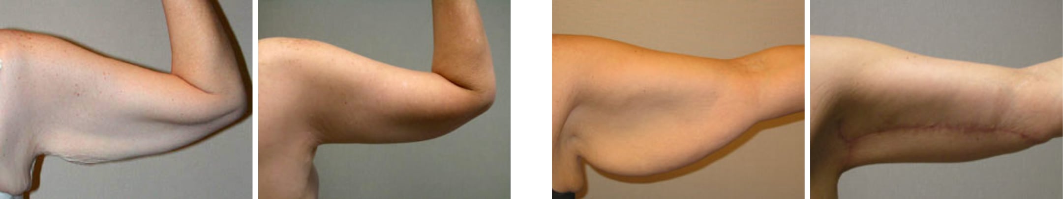 Best Arm Lift In Michgian ()