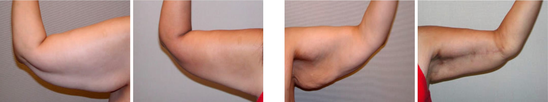 Best Arm Lift In Michgian ()