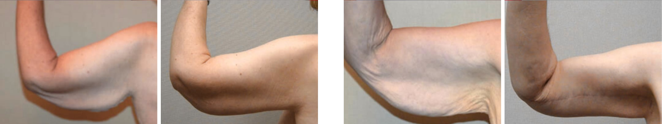 Best Arm Lift In Michgian ()