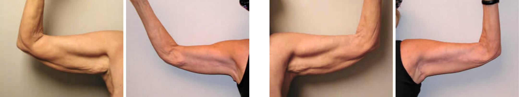 Best Arm Lift In Michgian ()