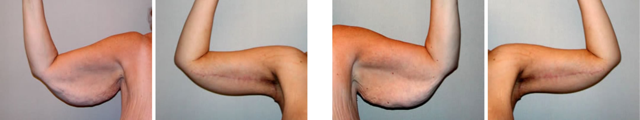 Best Arm Lift In Michgian ()