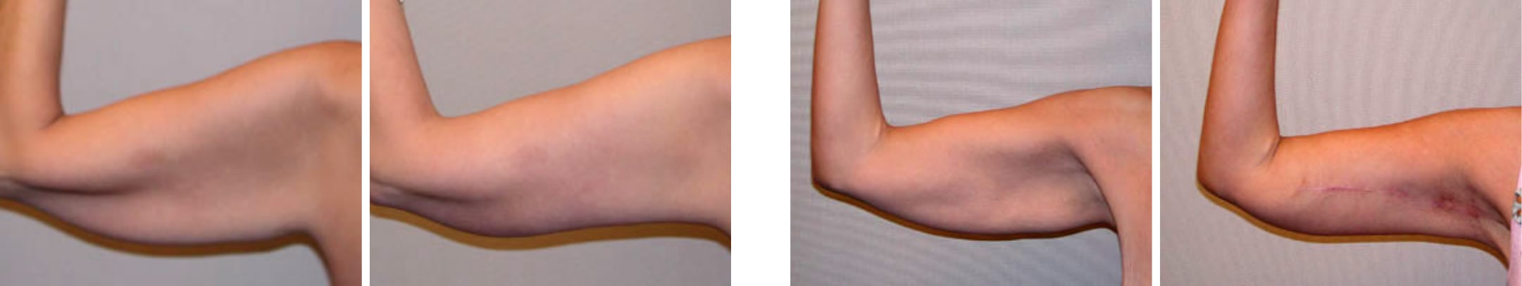 Best Arm Lift In Michgian