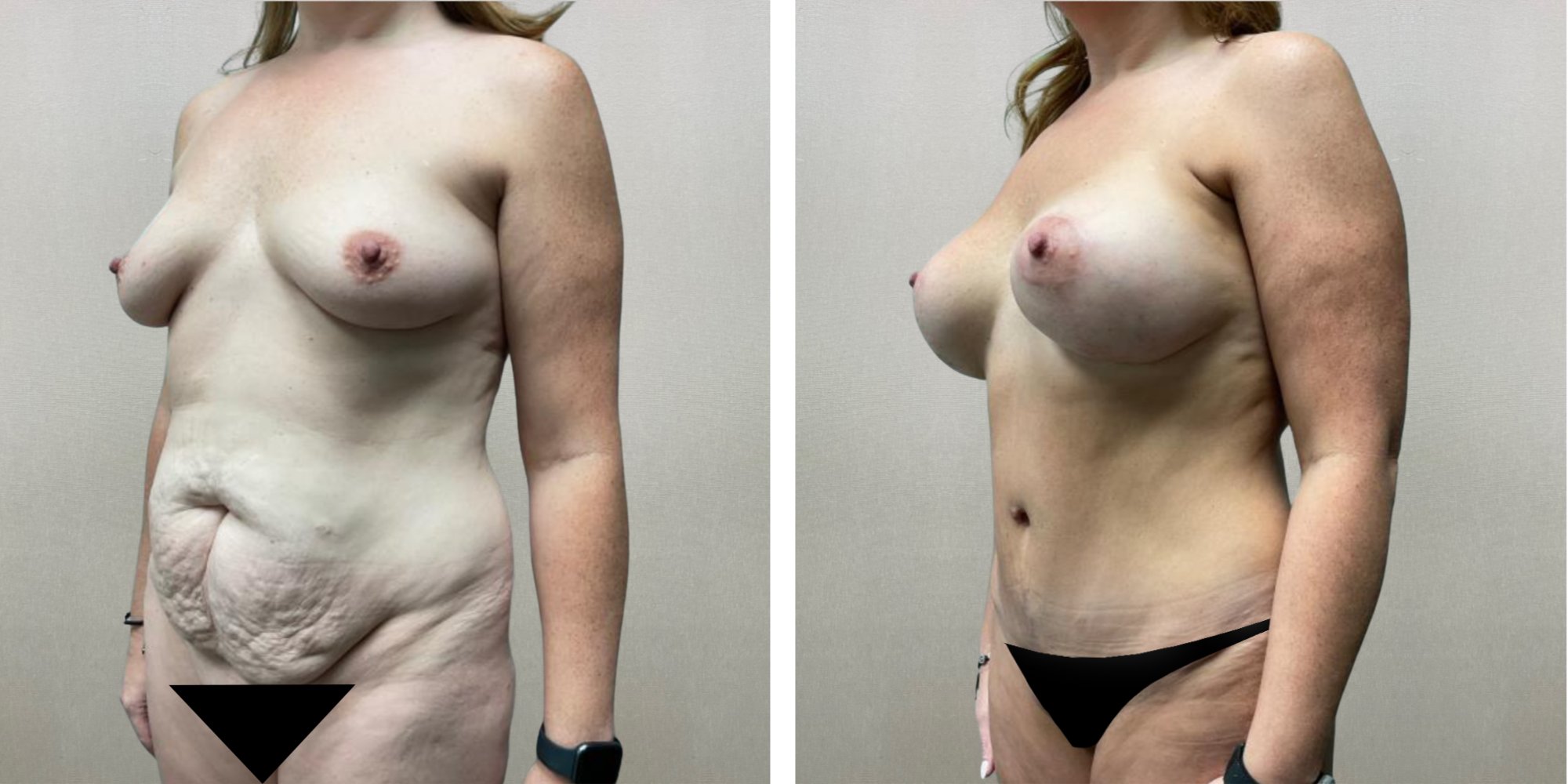 Best Mommy Makeover in Birmingham Michigan ()