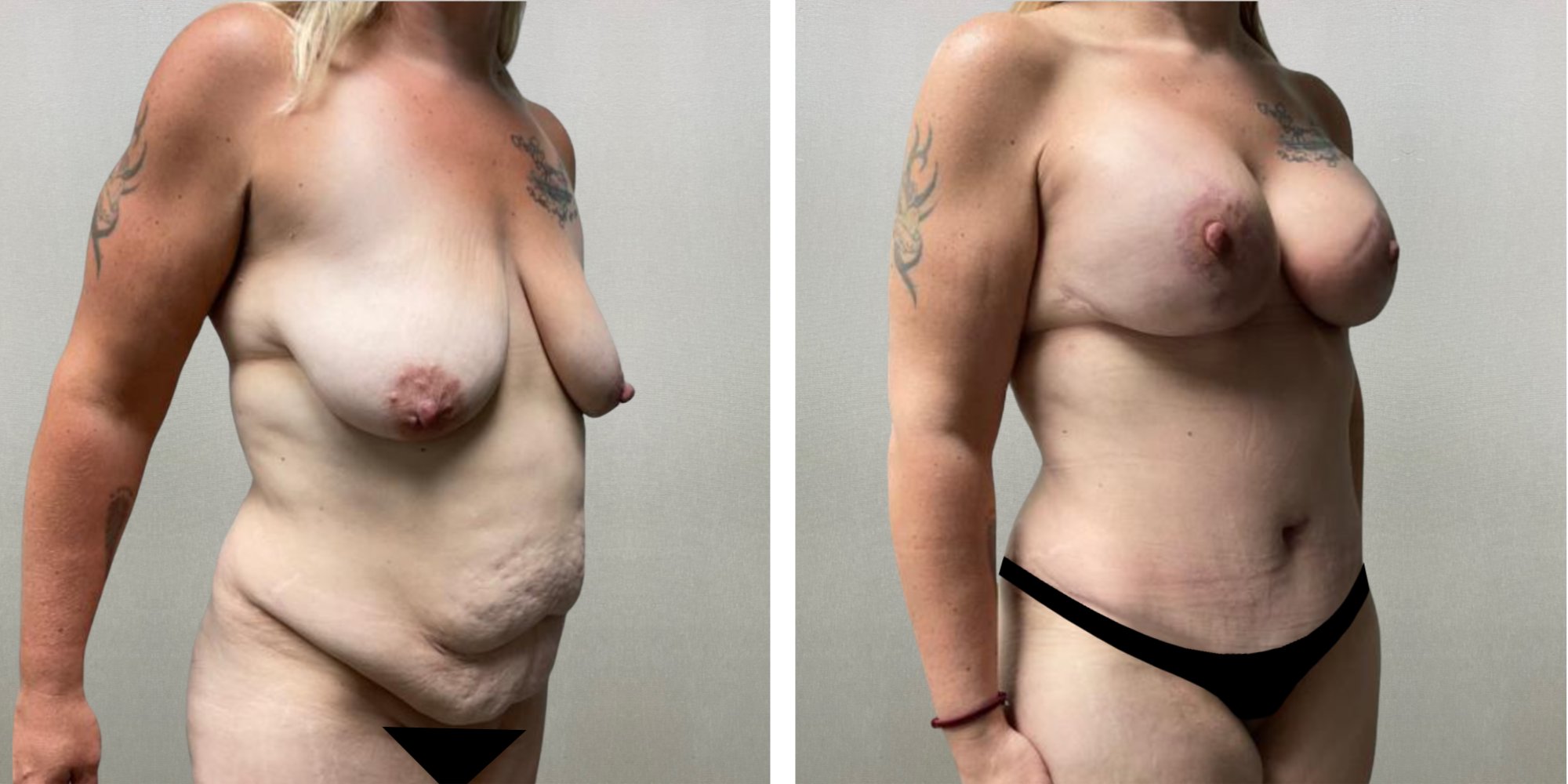 Best Mommy Makeover in Michigan ()
