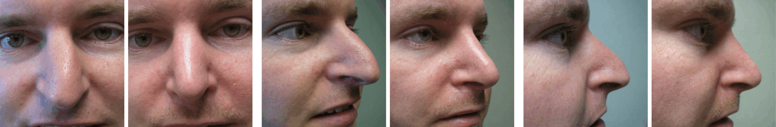 Best Rhinoplasty in Michigan ()