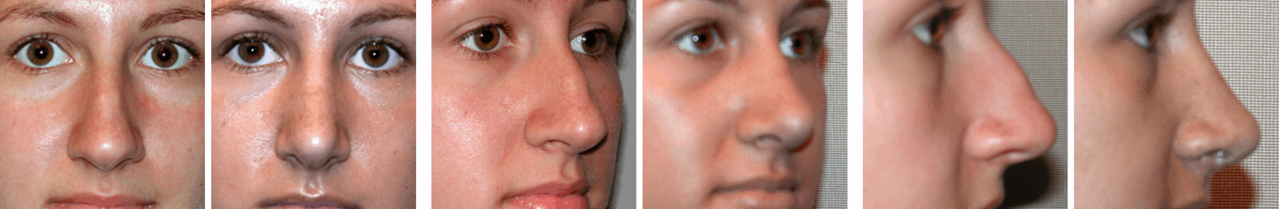 Best Rhinoplasty in Michigan ()