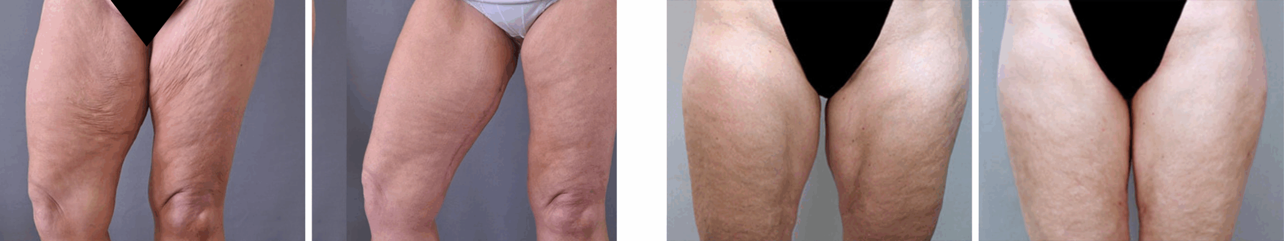 Best Thigh Lift In Michgian Best Thigh Lift In Michgian