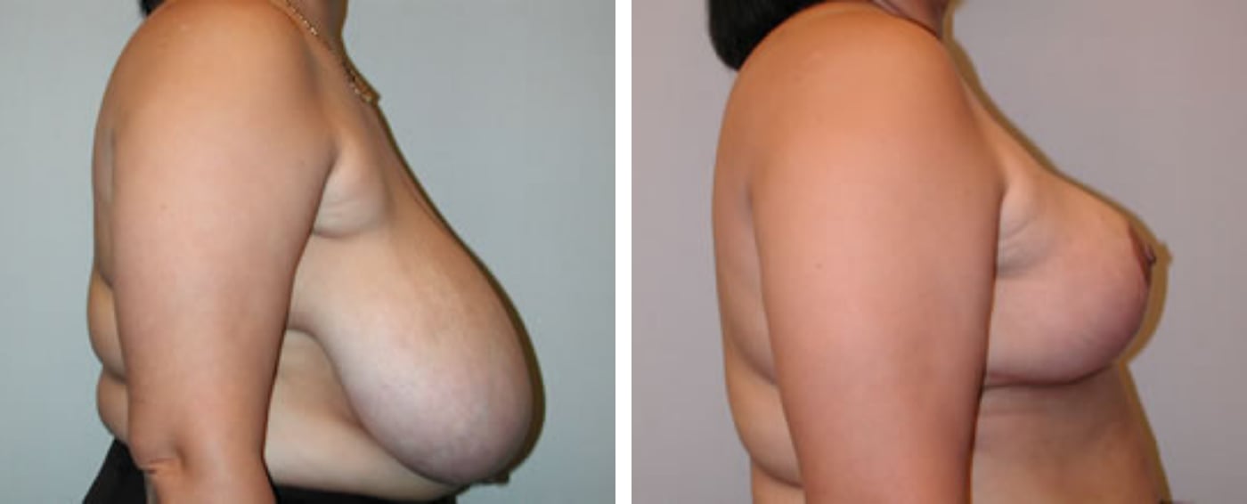 Breast Reduction C
