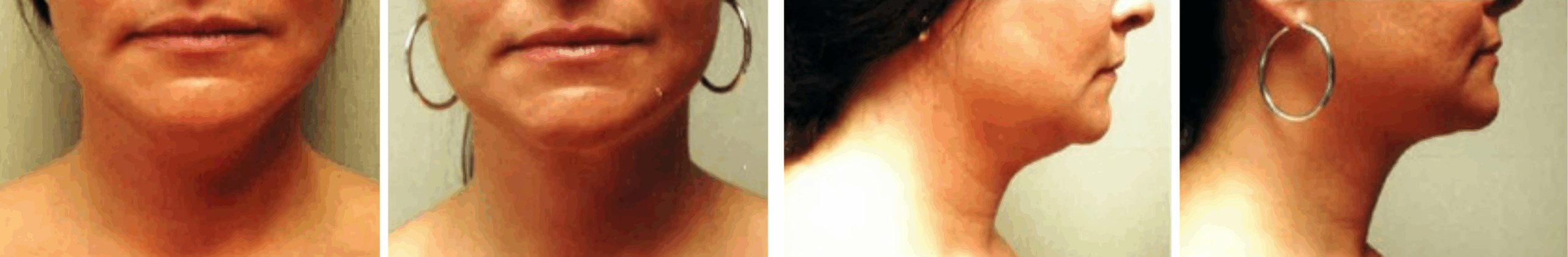 Chin Lipo In Michigan ()