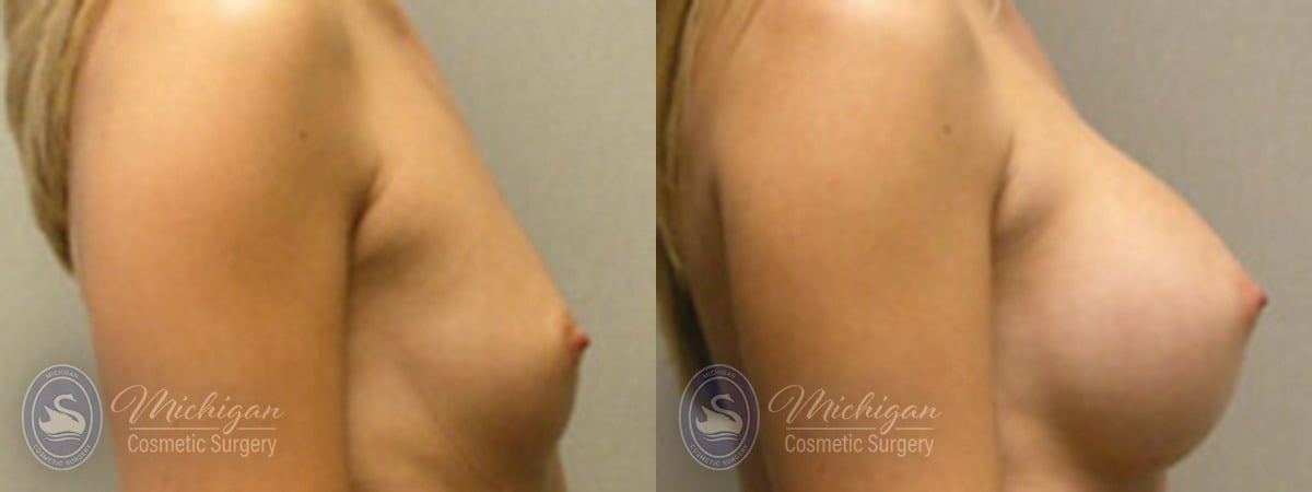 Michigan Cosmetic Surgery Southfield Breast Augmentation P