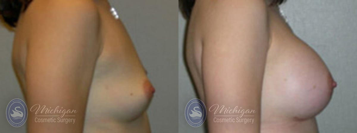 Michigan Cosmetic Surgery Southfield Breast Augmentation P