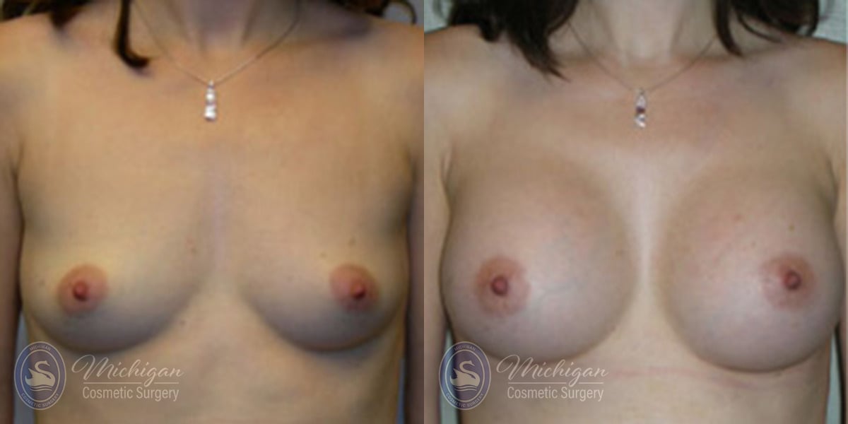 Michigan Cosmetic Surgery Southfield Breast Augmentation P