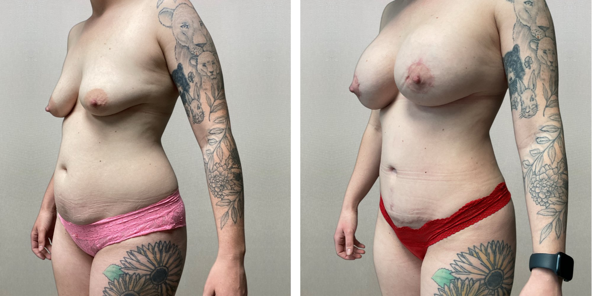 Mommy Makeover in Detroit metro ()