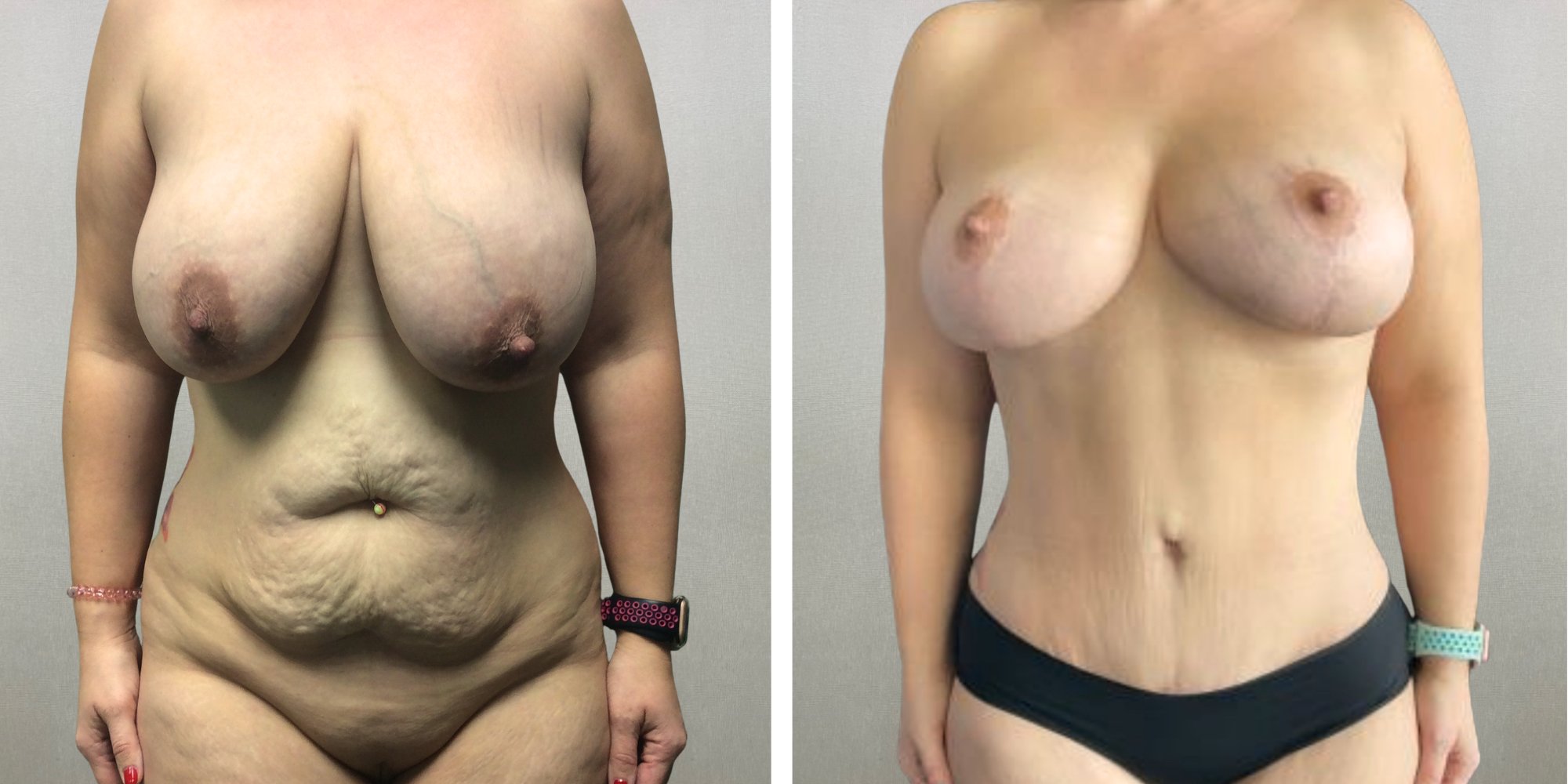 Mommy Makeover with Tummy Tuck and Lolipop in Michigan