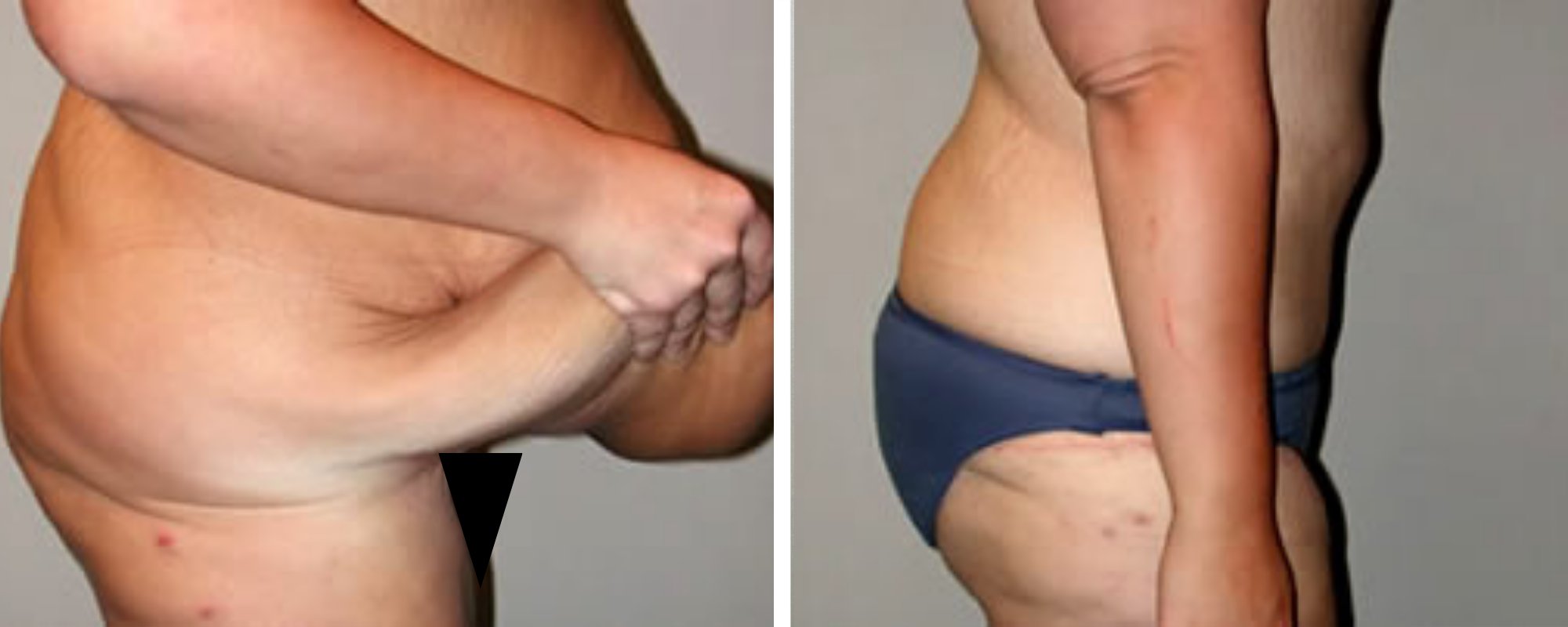 Weight Loss Makeover Body Lift in Michigan ()